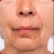 Tissue Tone Before