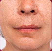 Tissue Tone After